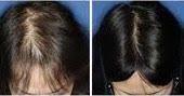 Stem Cells Injections for Hair